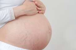 Vergeturile în sarcină: soluții pentru prevenirea și combaterea lor