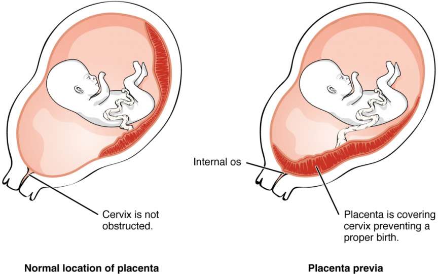 Sarcina joasă, adică placenta previa. Tot ce trebuie să știi!