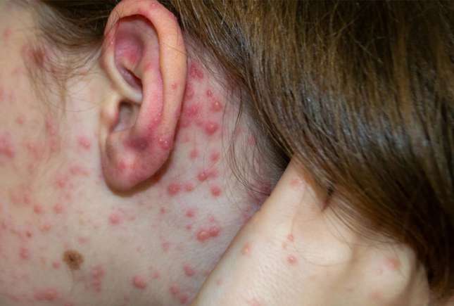 Alertă de rujeolă în Capitală: 5 copii și 3 adulți infectați. Autoritățile cer vaccinare urgentă