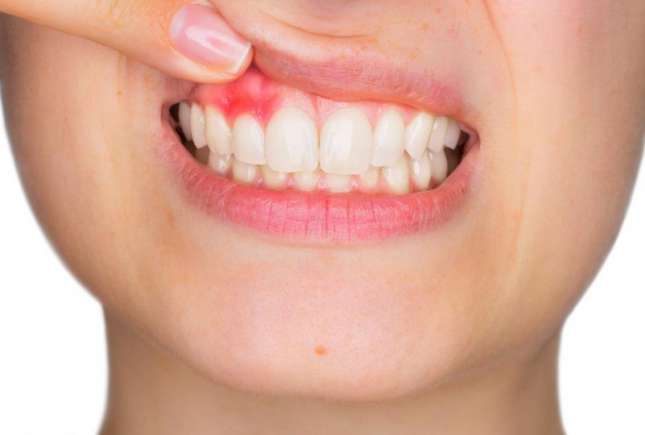 Ce boli grave pot ascunde gingiile vineții, maro, albe sau foarte roșii