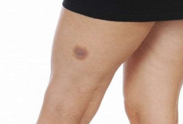Pregătește-te pentru vară și scapă de vânătăi! Trucuri simple pentru vacanță