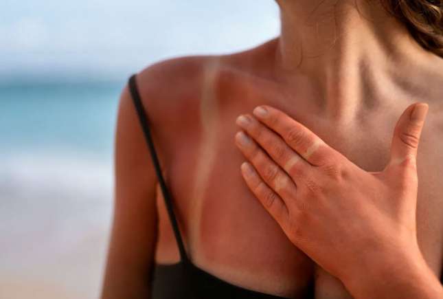 Aloe vera și uleiul de cocos te pot ajuta după arsuri solare – dar doar dacă le folosești la momentul potrivit