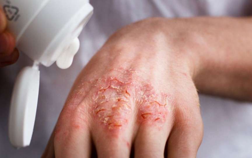 Eczema: cauze, simptome, prevenţie