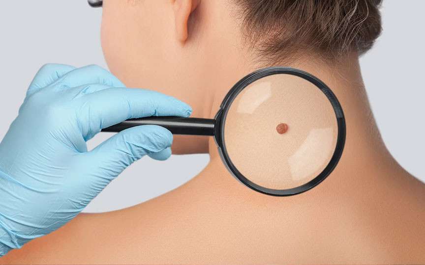 Ce se întâmplă dacă rupi o aluniță? Riscuri și recomandări medicale
