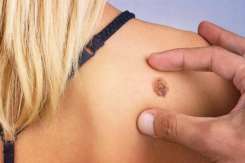 Cancerul de piele nu e doar de la alunițe, ci poate fi și orice leziune care nu se vindecă în 6 săptămâni