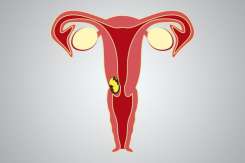 Cancer vaginal: factori de risc și simptome