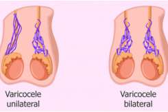Varicocelul  - o cauză frecventă de infertilitate