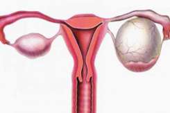 Chisturile ovariene: 13 mituri spulberate de medicul ginecolog