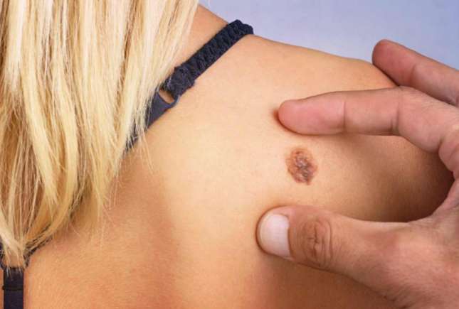 Cancerul de piele nu e doar de la alunițe, ci poate fi și orice leziune care nu se vindecă în 6 săptămâni