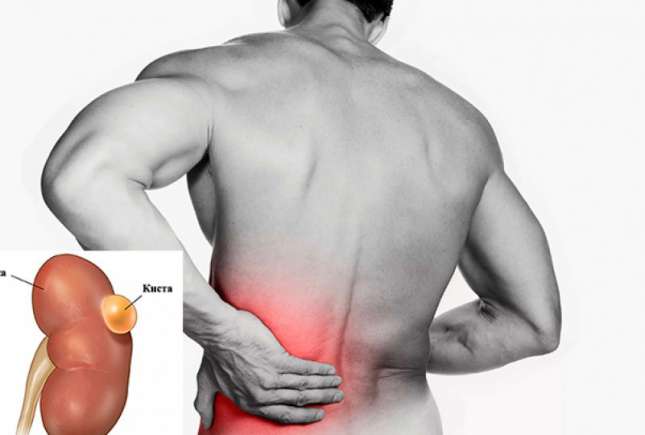 Chistul renal: simptome și cauze