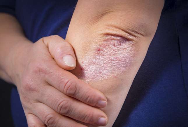 Psoriazis: cauze, simptome, tratament