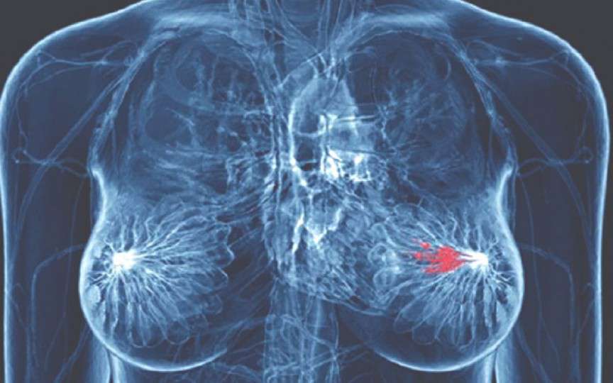 Cancerul mamar ocupă primul loc în morbiditatea prin tumori maligne la femei. 1000 de cazuri noi înregistrate anual în Moldova