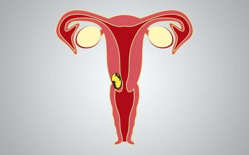 Cancer vaginal: factori de risc și simptome