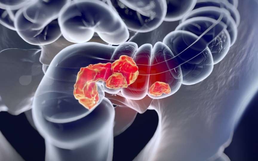 Patru semne principale ale cancerului de colon, dar pe care majoritatea oamenilor le ignoră