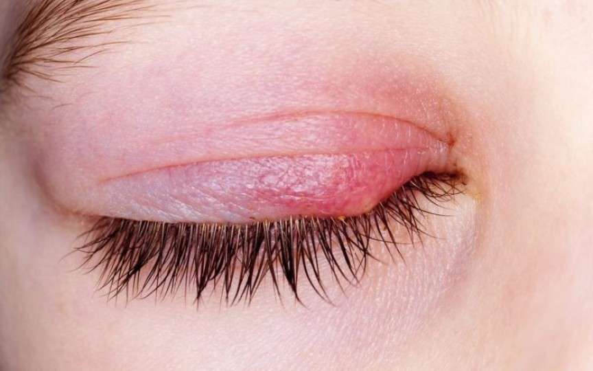 Cum se tratează ulciorul, infecția oculară care apare de la mic la mare