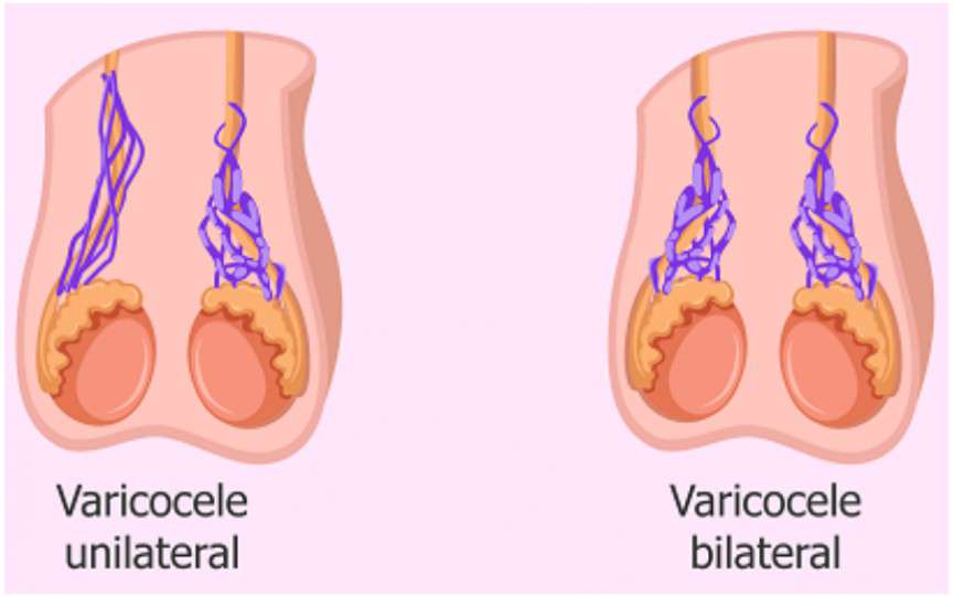 Varicocelul  - o cauză frecventă de infertilitate