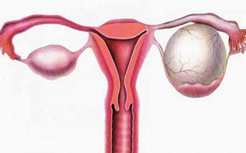 Chisturile ovariene: 13 mituri spulberate de medicul ginecolog