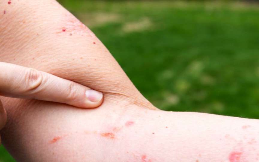 5 remedii pentru iritațiile produse de iedera otrăvitoare
