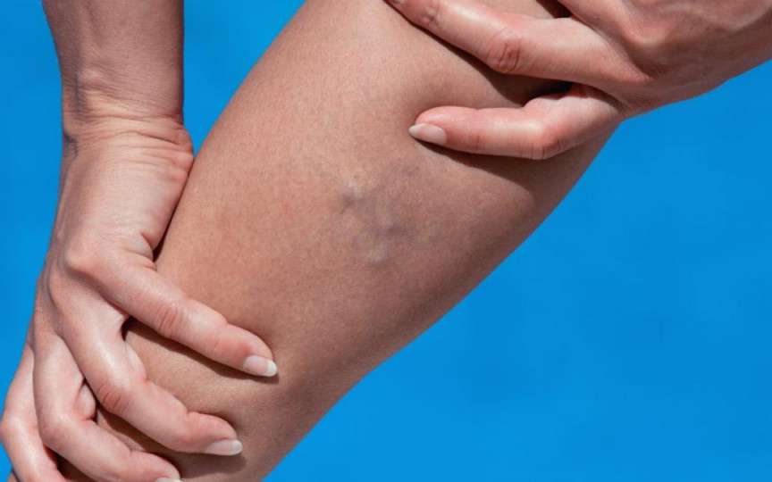 Trei zone ale corpului care arată că ai probleme cu cheagurile de sânge