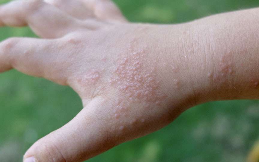 Dishidroza: de ce apar bășicile cu lichid pe palme și degete?