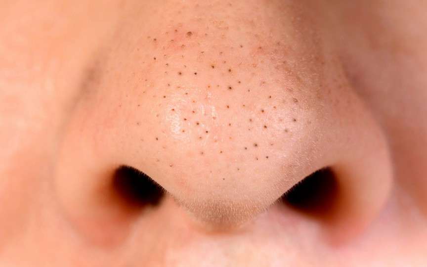 Tratament natural pentru punctele negre: exfoliant DIY cu ingrediente ieftine și eficiente