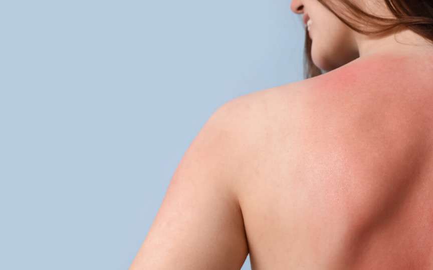 Arsuri solare? 5 ponturi să te refaci rapid