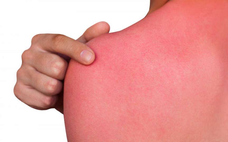 Aşa calmezi natural pielea arsă de soare! Ce să faci dacă au apărut băşici