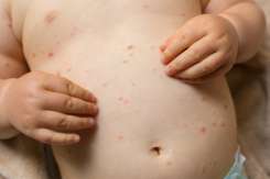 8 mituri despre vaccinare care au provocat epidemii de rujeolă în secolul XXI