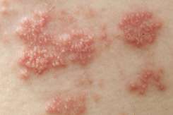 Zona Zoster: cauze, simptome, tratament, prevenţie
