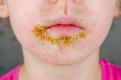 Impetigo: tot ce trebuie să știi despre infecția contagioasă a pielii, la copii