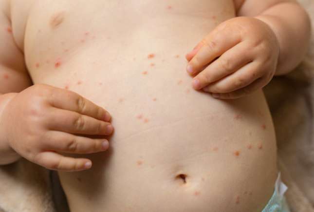 8 mituri despre vaccinare care au provocat epidemii de rujeolă în secolul XXI