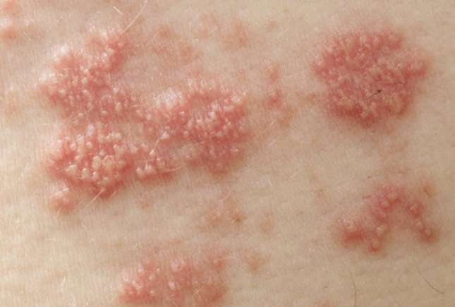 Zona Zoster: cauze, simptome, tratament, prevenţie