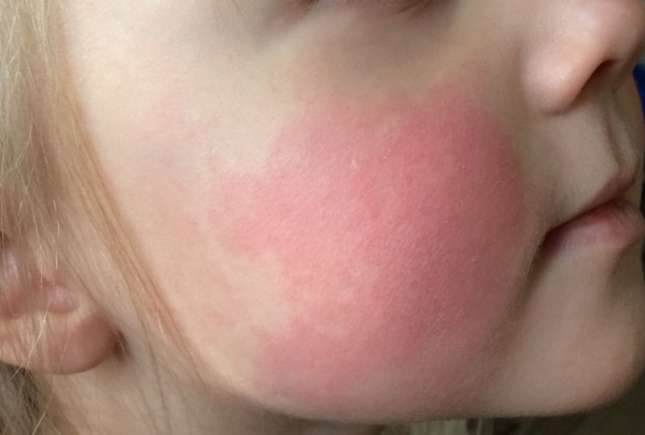 Eritemul infecțios la copii – o boală extrem de contagioasă. Cum se manifestă!