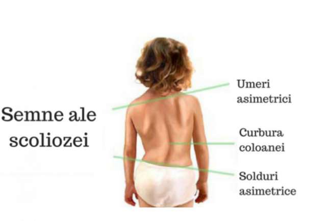 3 exerciții fizice care pot corecta scolioza la copii