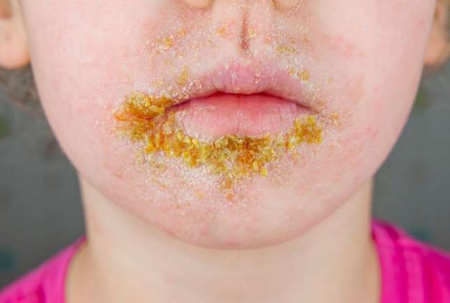 Impetigo: tot ce trebuie să știi despre infecția contagioasă a pielii, la copii