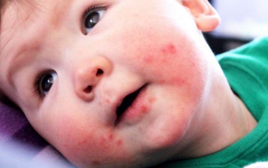 ​Atenție la boala mână-gură-picior! Face ravagii în rândul copiilor