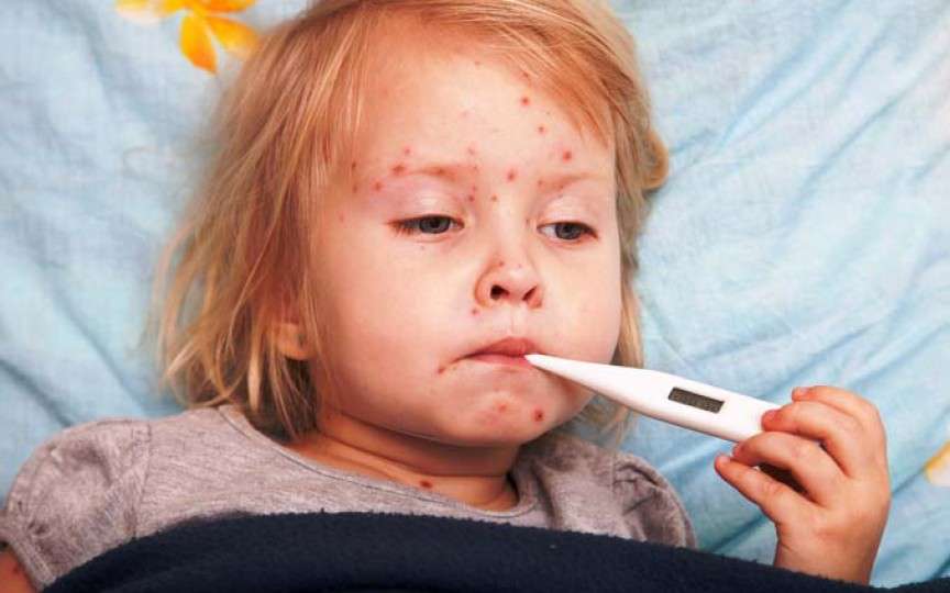Boala bubelor dulci: cât de contagioasă este și cum se tratează