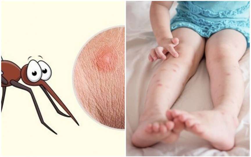 7 tipuri de înțepături de insecte și cum să le deosebești