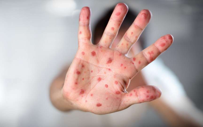 În Israel a murit de rujeolă o fetiță de 1,5 ani. Liderii religioși au făcut apel la părinți să-și vaccineze copiii