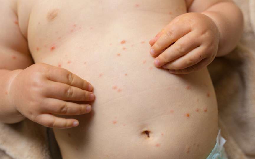 8 mituri despre vaccinare care au provocat epidemii de rujeolă în secolul XXI