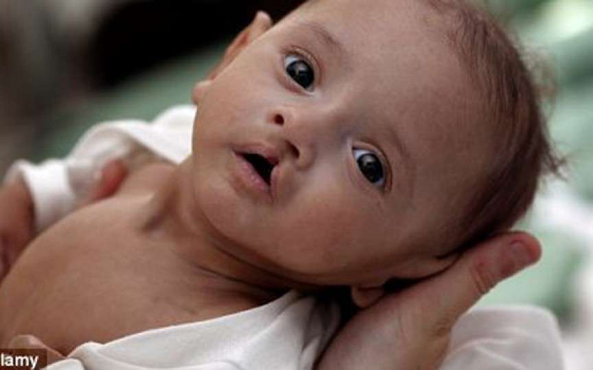 Medic primar geriatrie despre cheiloschizis (buza de iepure)