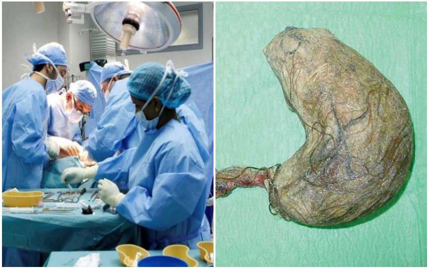 Intervenție chirurgicală neobișnuită: Medicii au înlăturat din stomacul unei adolescente un cheag de păr de 6 kg