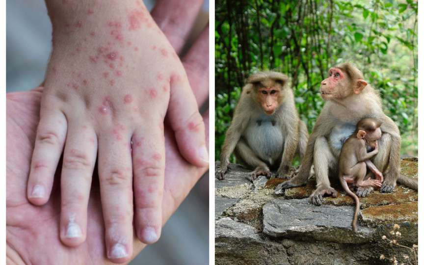 Variola s-a întors? Explicăm dacă ai motive de îngrijorare