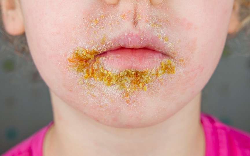 Impetigo: tot ce trebuie să știi despre infecția contagioasă a pielii, la copii