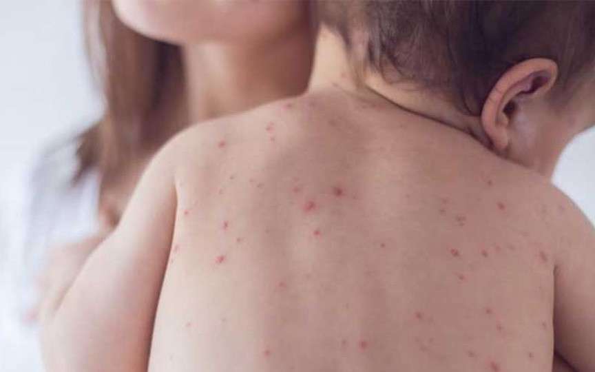 Ce este rozeola la copii și cum o recunoști: simptome, cauze și evoluție