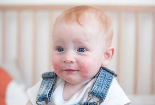 Cum să faci baie copilului dacă are dermatită atopică – sfaturi de la medic dermatolog