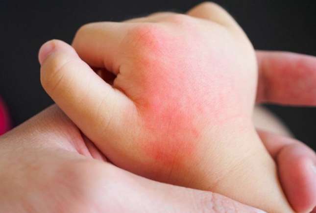 Medic dermatolog despre cum recunoaștem alergia solară la copii