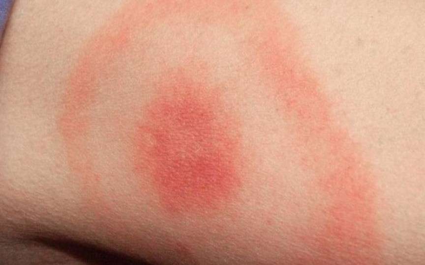 Borelioza sau „boala mușcăturii de căpușă” – tot ce trebuie să știi despre această boală în plin sezon de căpușe