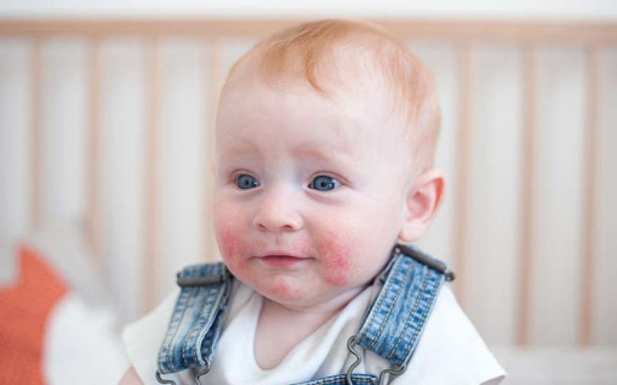 Cum să faci baie copilului dacă are dermatită atopică – sfaturi de la medic dermatolog