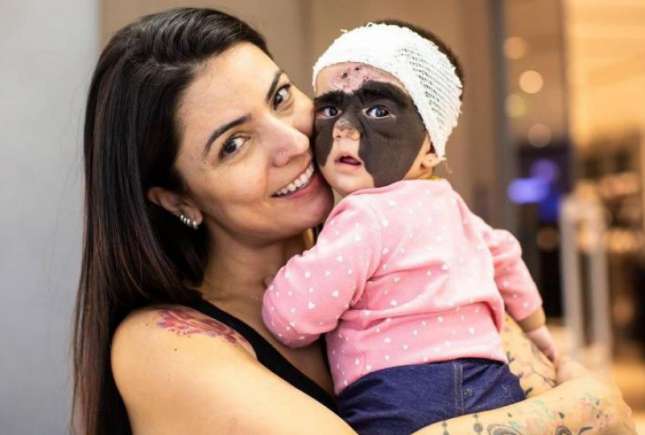Minune în cazul fetiţei născute cu „masca lui Batman” pe faţă. Iată cum arată acum micuţa, după şedinţele de tratament